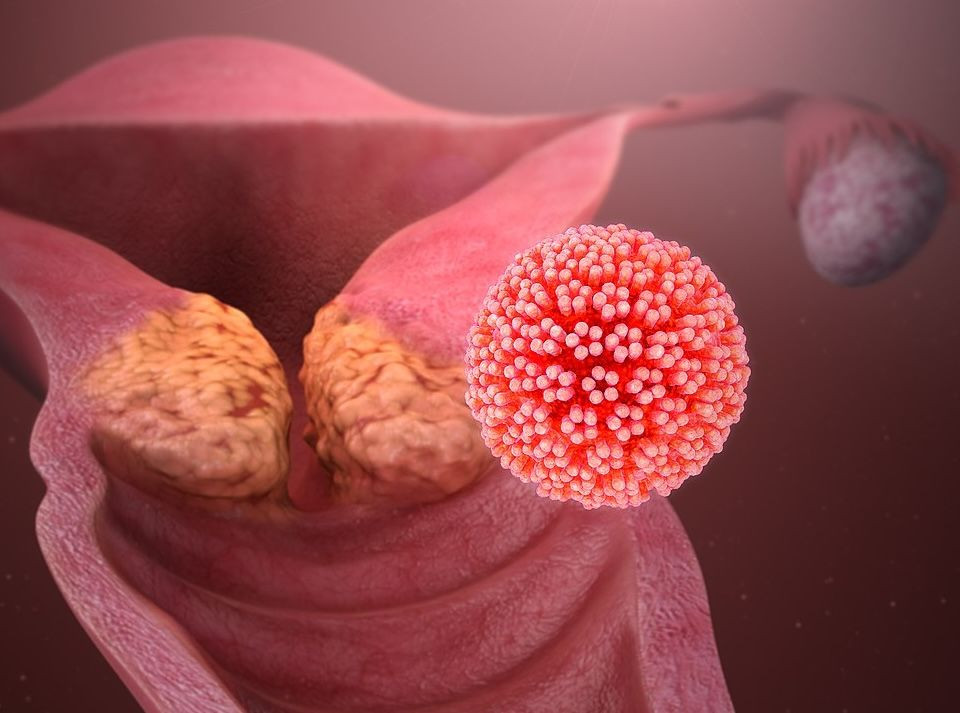 Cervical cancer